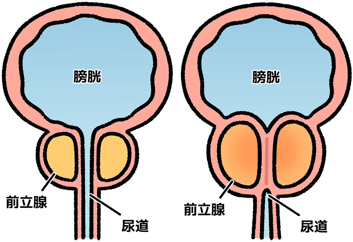 前立腺肥大症の原因